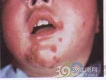  皮肤病变的微观透视：从新生儿脓疱到色素沉着的演化逻辑 情感心理